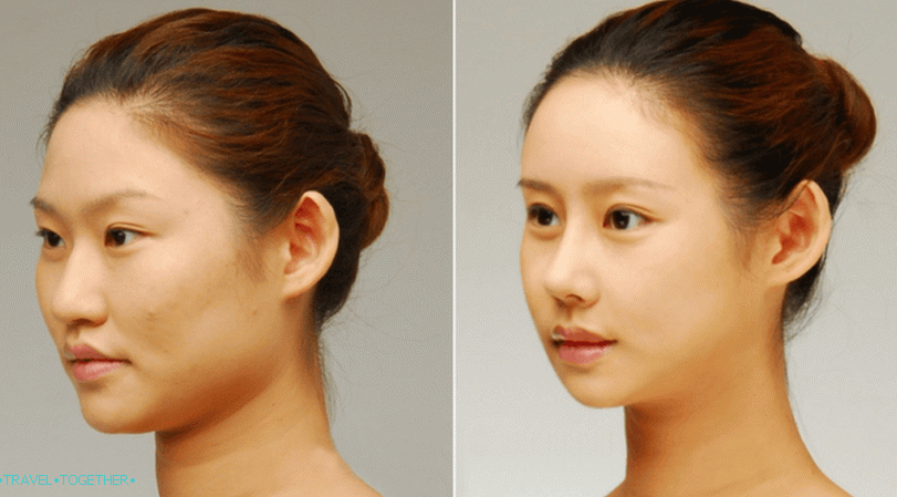 „Blepharoplastika